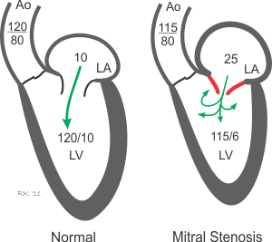 mitral stenosis cardiac chamber pressures